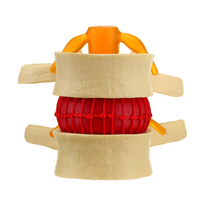 Medical Lumbar Vertebrae Model Props Anatomical Spine Herniation Teaching Tool